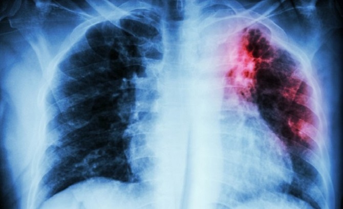 Maryland Treats Patient With Drug-Resistant Tuberculosis: Were Other People Exposed?