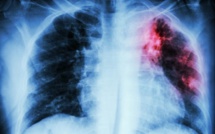 Maryland Treats Patient With Drug-Resistant Tuberculosis: Were Other People Exposed?